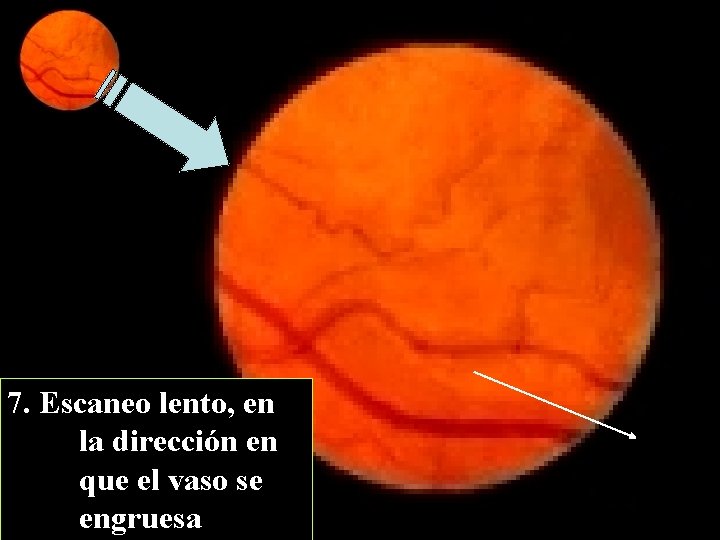 7. Escaneo lento, en la dirección en que el vaso se engruesa 