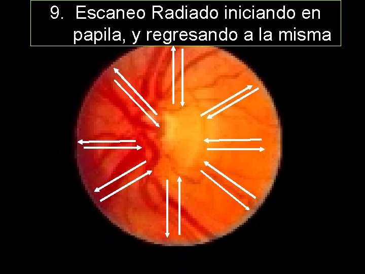 9. Escaneo Radiado iniciando en papila, y regresando a la misma 