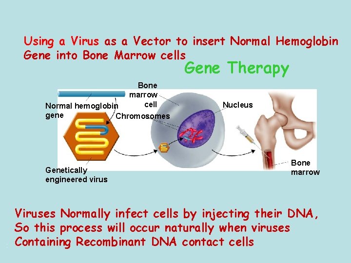 Using a Virus as a Vector to insert Normal Hemoglobin Gene into Bone Marrow