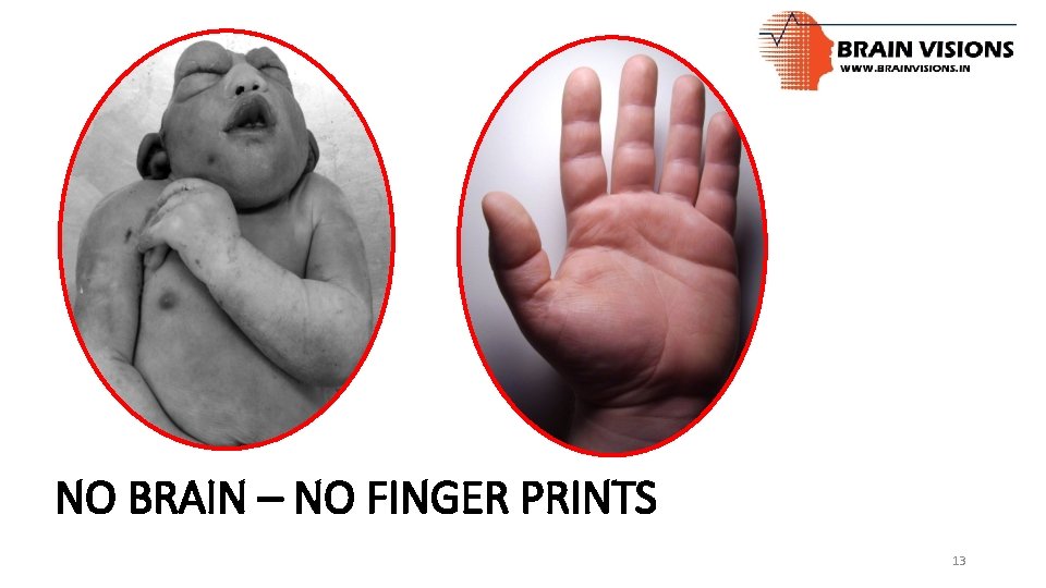 NO BRAIN – NO FINGER PRINTS 13 