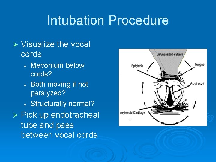 Intubation Procedure Ø Visualize the vocal cords l l l Ø Meconium below cords?