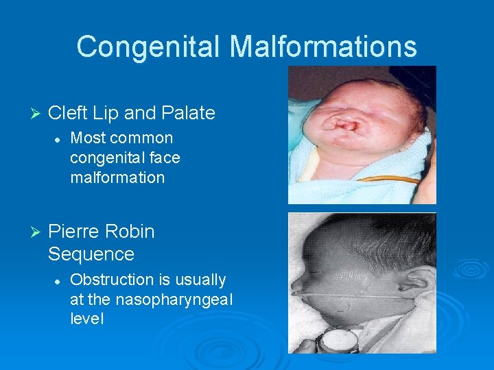 Congenital Malformations Ø Cleft Lip and Palate l Ø Most common congenital face malformation