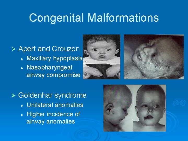 Congenital Malformations Ø Apert and Crouzon l l Ø Maxillary hypoplasia Nasopharyngeal airway compromise