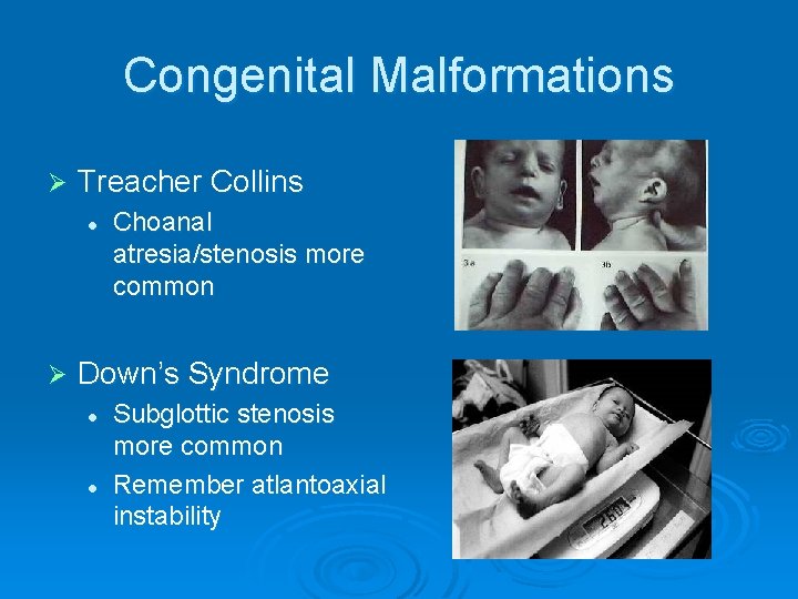 Congenital Malformations Ø Treacher Collins l Ø Choanal atresia/stenosis more common Down’s Syndrome l