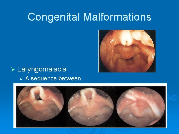 Congenital Malformations Ø Laryngomalacia l A sequence between fully formed to atresia 