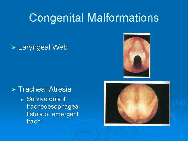 Congenital Malformations Ø Laryngeal Web Ø Tracheal Atresia l Survive only if tracheoesophageal fistula