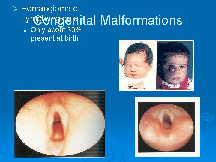 Ø Hemangioma or Lymphangioma Congenital l Only about 30% present at birth Malformations 