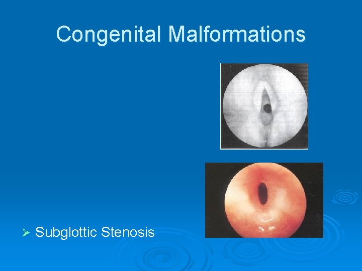 Congenital Malformations Ø Subglottic Stenosis 