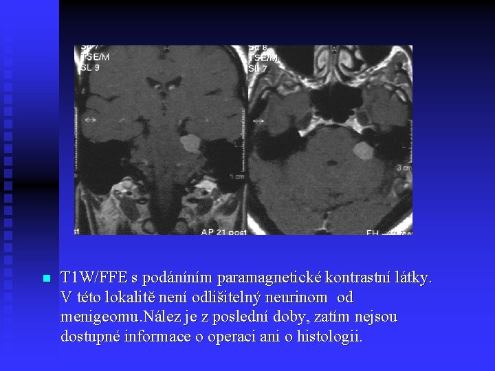 n T 1 W/FFE s podáníním paramagnetické kontrastní látky. V této lokalitě není odlišitelný