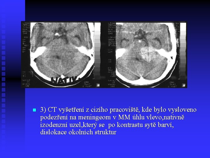 n 3) CT vyšetření z cizího pracoviště, kde bylo vysloveno podezření na meningeom v