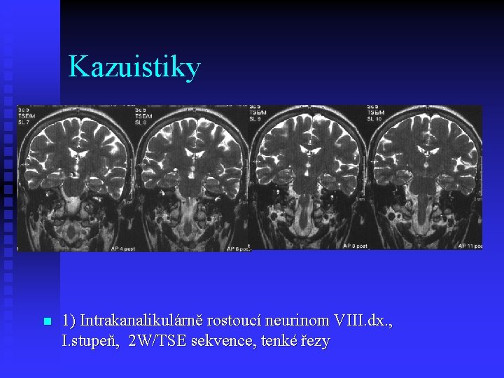 Kazuistiky n 1) Intrakanalikulárně rostoucí neurinom VIII. dx. , I. stupeň, 2 W/TSE sekvence,