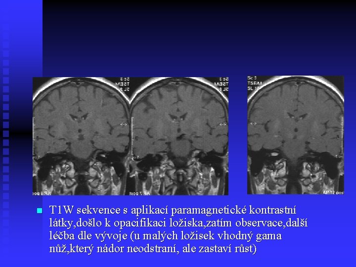 n T 1 W sekvence s aplikací paramagnetické kontrastní látky, došlo k opacifikaci ložiska,