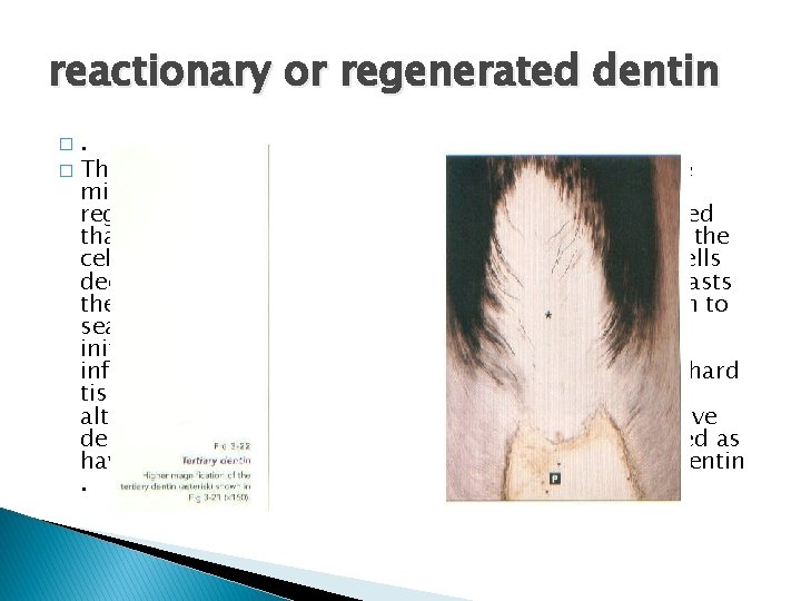 reactionary or regenerated dentin. � Those odontoblasts that are killed are replaced by the