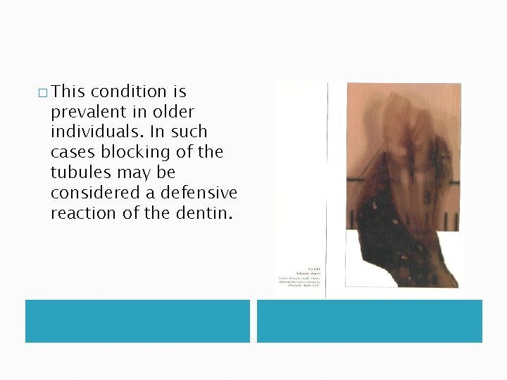 � This condition is prevalent in older individuals. In such cases blocking of the