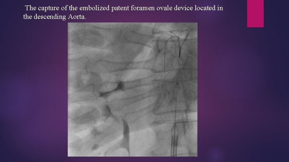 The capture of the embolized patent foramen ovale device located in the descending Aorta.