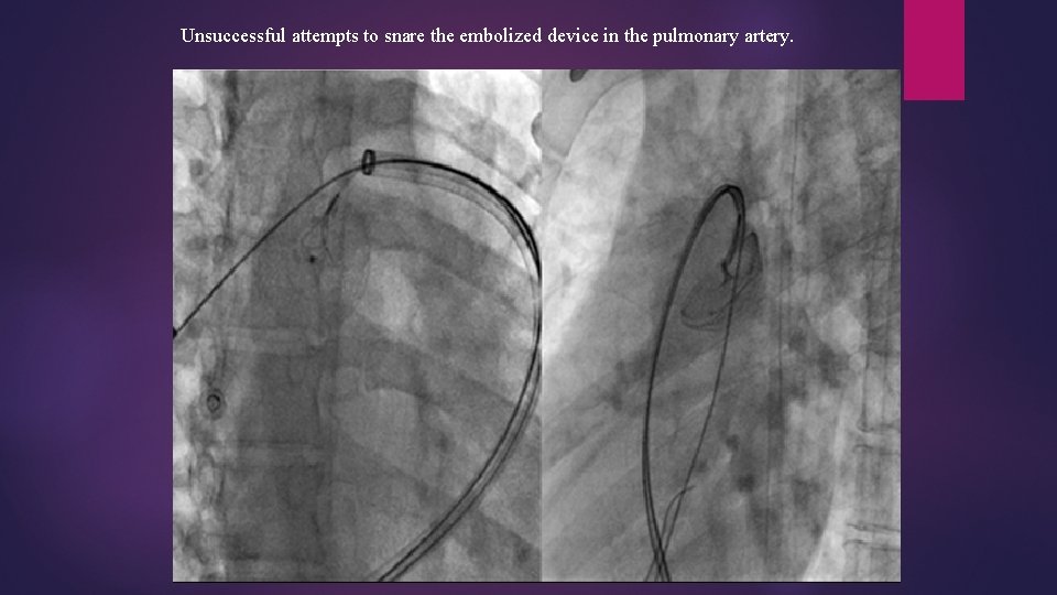 Unsuccessful attempts to snare the embolized device in the pulmonary artery. 
