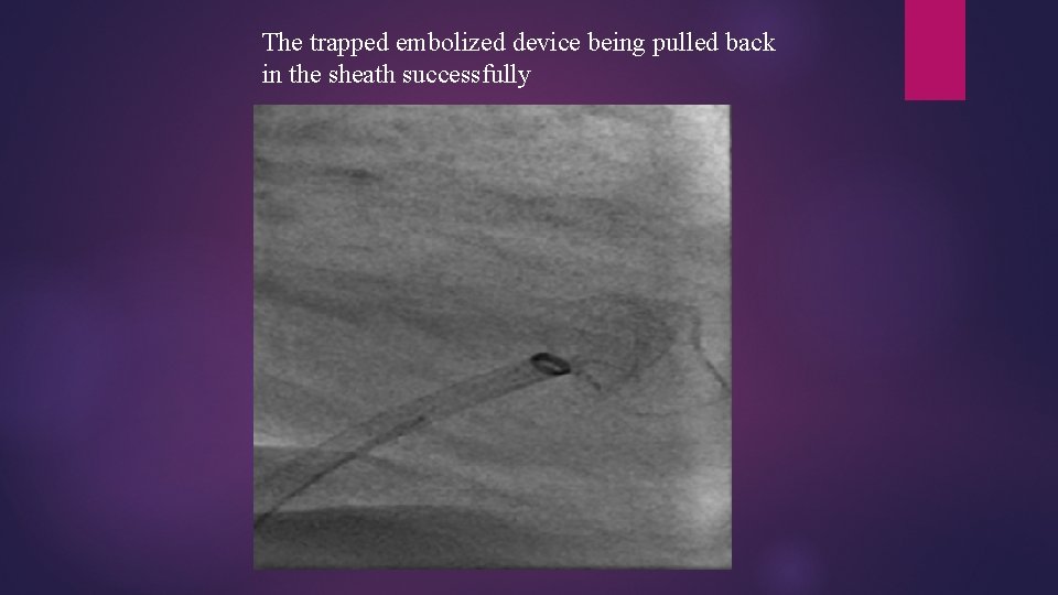 The trapped embolized device being pulled back in the sheath successfully 