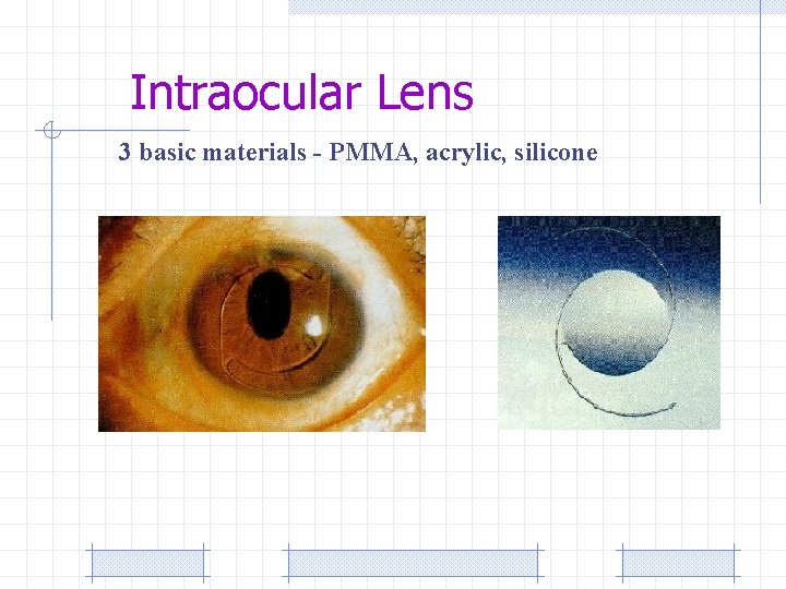 Intraocular Lens 3 basic materials - PMMA, acrylic, silicone 