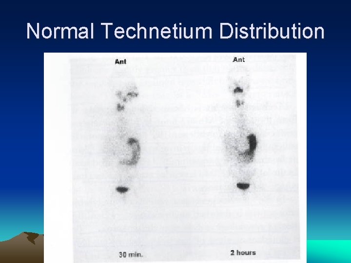 Normal Technetium Distribution 