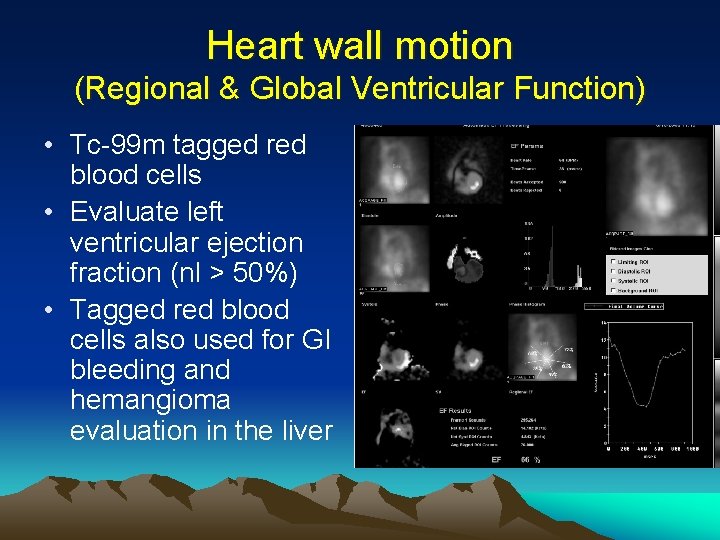 Heart wall motion (Regional & Global Ventricular Function) • Tc-99 m tagged red blood