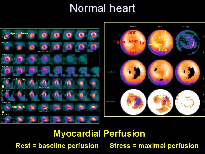 Normal heart ant Apex to base s sep Apex lat inf LAD Cx RCA