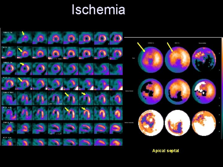 Ischemia Apical septal 