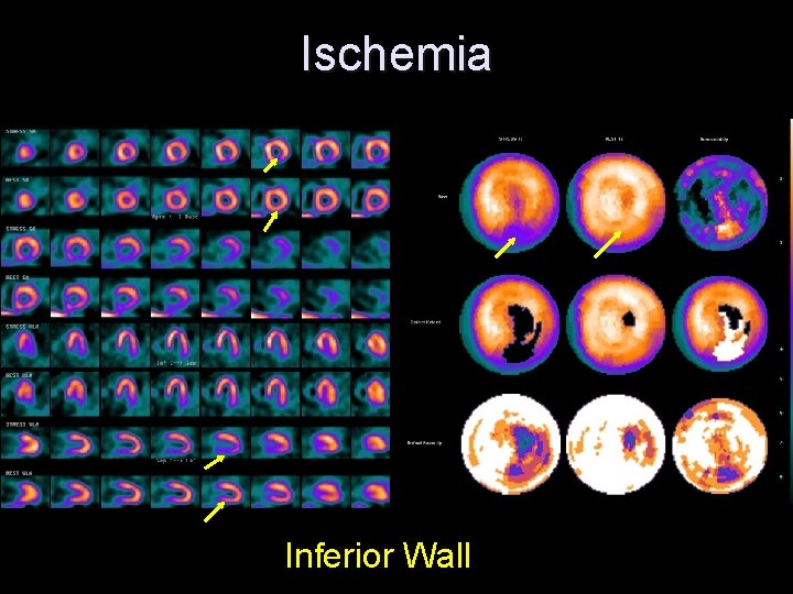 Ischemia Inferior Wall 