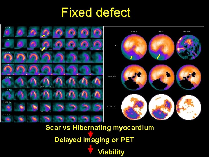 Fixed defect Scar vs Hibernating myocardium Delayed imaging or PET Viability 