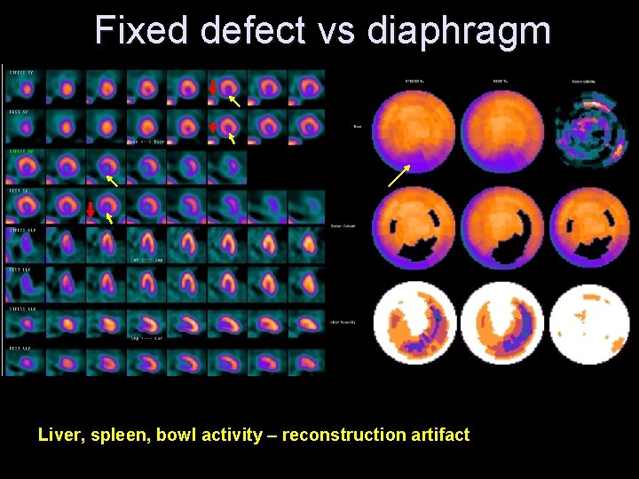 Fixed defect vs diaphragm Liver, spleen, bowl activity – reconstruction artifact 