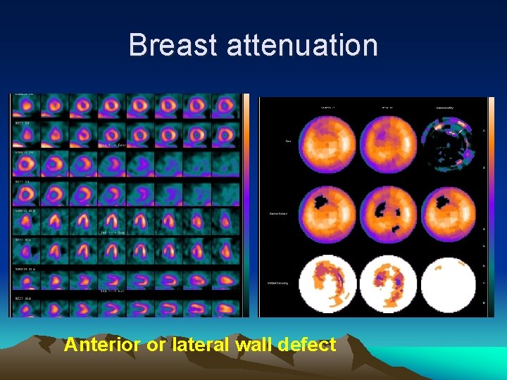 Breast attenuation Anterior or lateral wall defect 