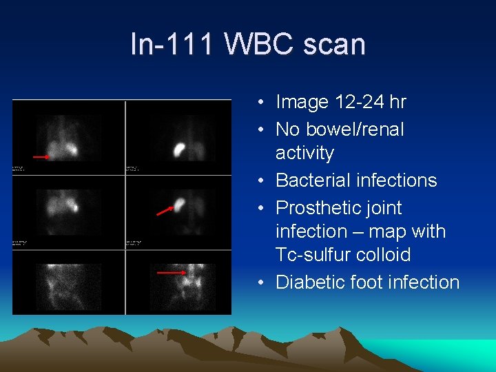 In-111 WBC scan • Image 12 -24 hr • No bowel/renal activity • Bacterial