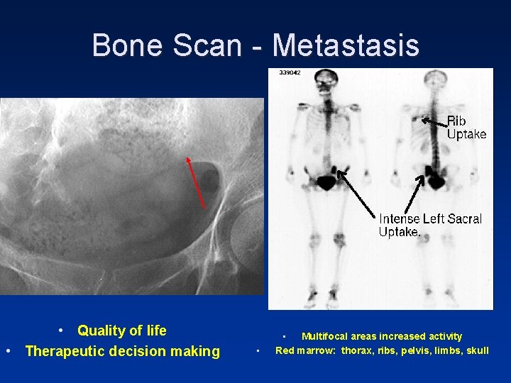 Bone Scan - Metastasis • Quality of life • Therapeutic decision making • •