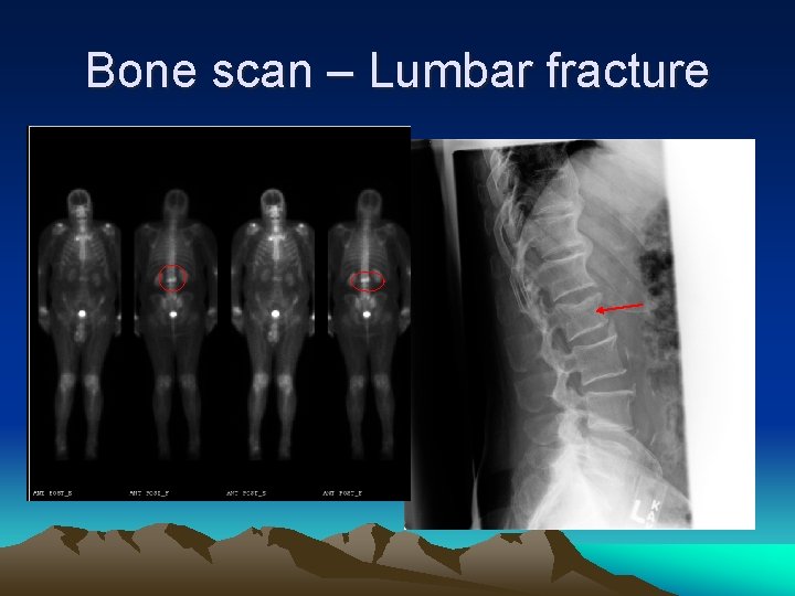 Bone scan – Lumbar fracture 