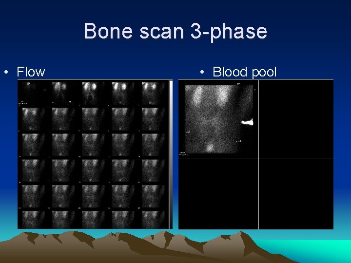 Bone scan 3 -phase • Flow • Blood pool 