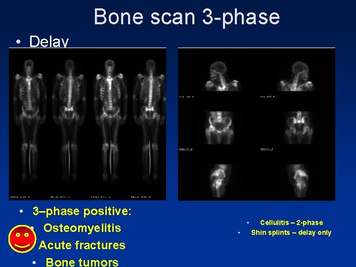 Bone scan 3 -phase • Delay • 3–phase positive: • Osteomyelitis • Acute fractures