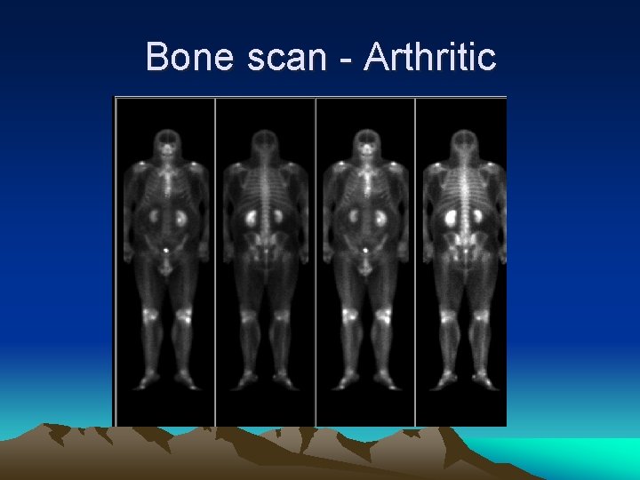 Bone scan - Arthritic 