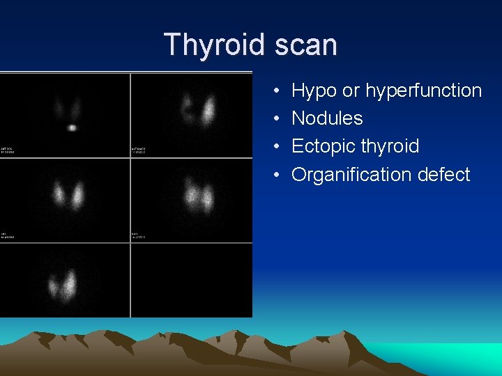 Thyroid scan • • Hypo or hyperfunction Nodules Ectopic thyroid Organification defect 