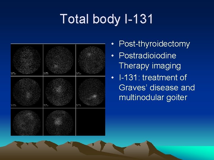 Total body I-131 • Post-thyroidectomy • Postradioiodine Therapy imaging • I-131: treatment of Graves’