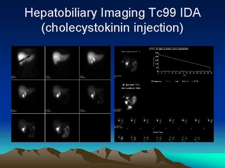 Hepatobiliary Imaging Tc 99 IDA (cholecystokinin injection) 