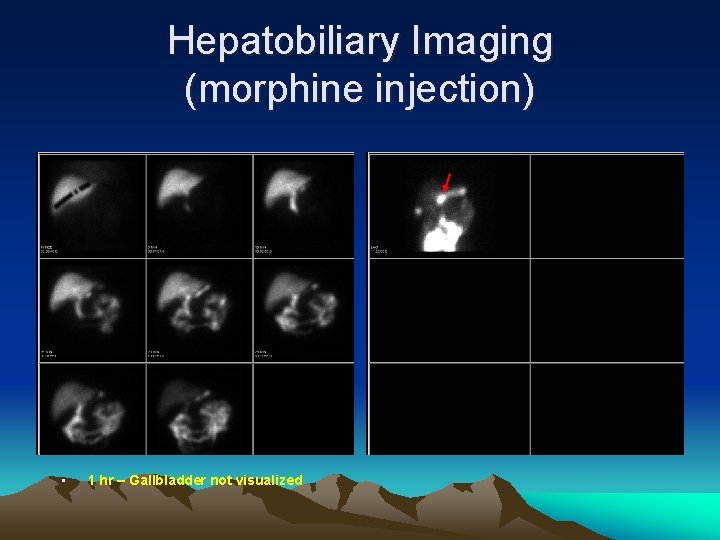 Hepatobiliary Imaging (morphine injection) • 1 hr – Gallbladder not visualized 