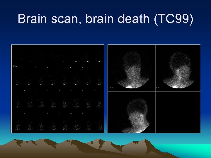 Brain scan, brain death (TC 99) 