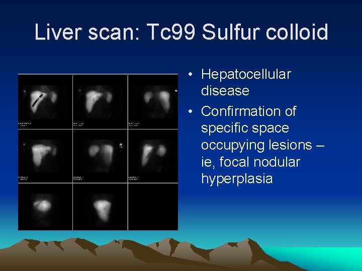 Liver scan: Tc 99 Sulfur colloid • Hepatocellular disease • Confirmation of specific space