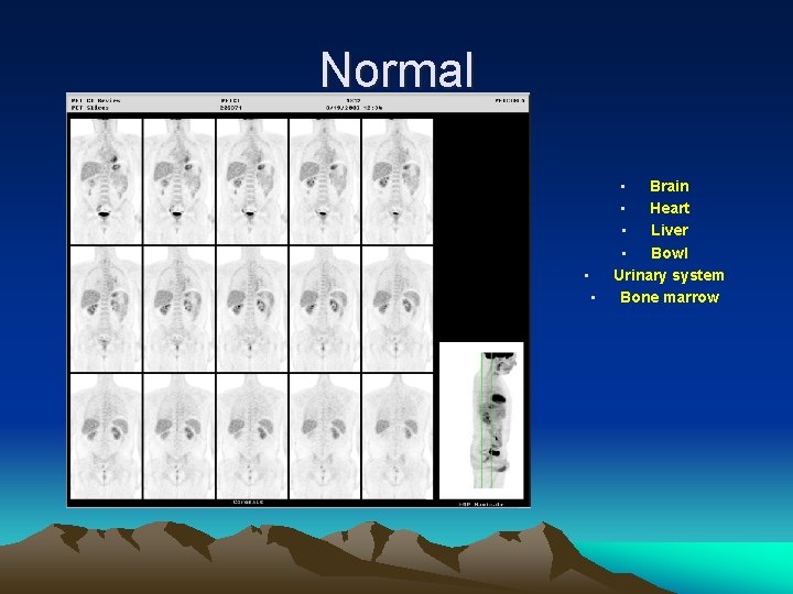 Normal • • • Brain • Heart • Liver • Bowl Urinary system Bone