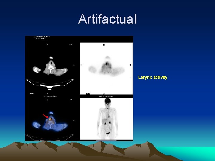 Artifactual • Larynx activity 