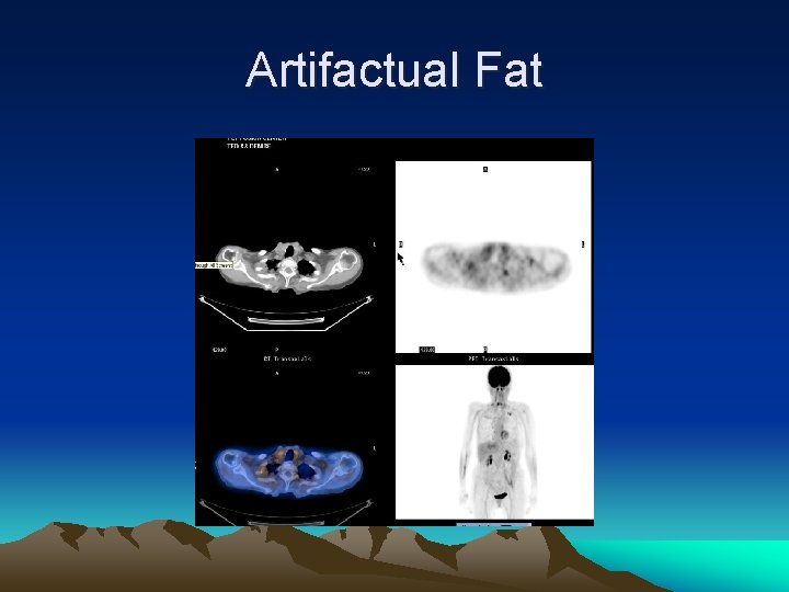 Artifactual Fat 