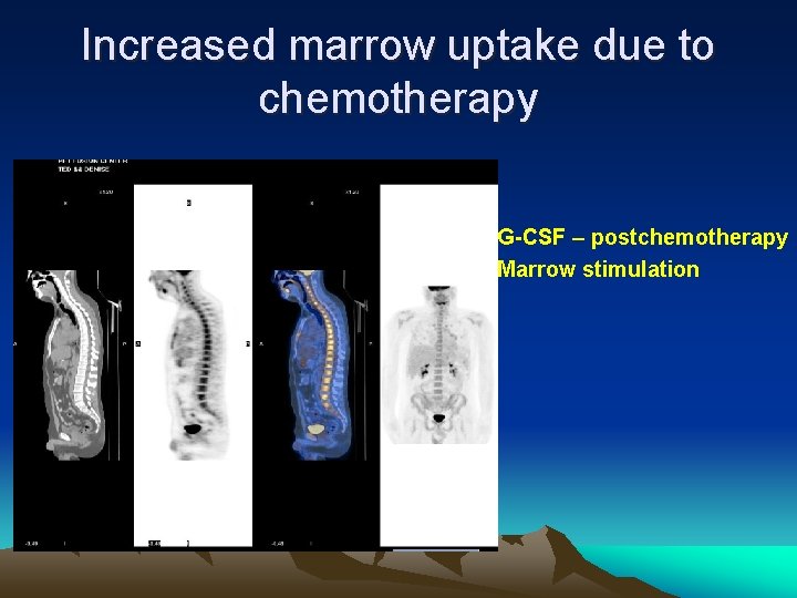 Increased marrow uptake due to chemotherapy G-CSF – postchemotherapy Marrow stimulation 