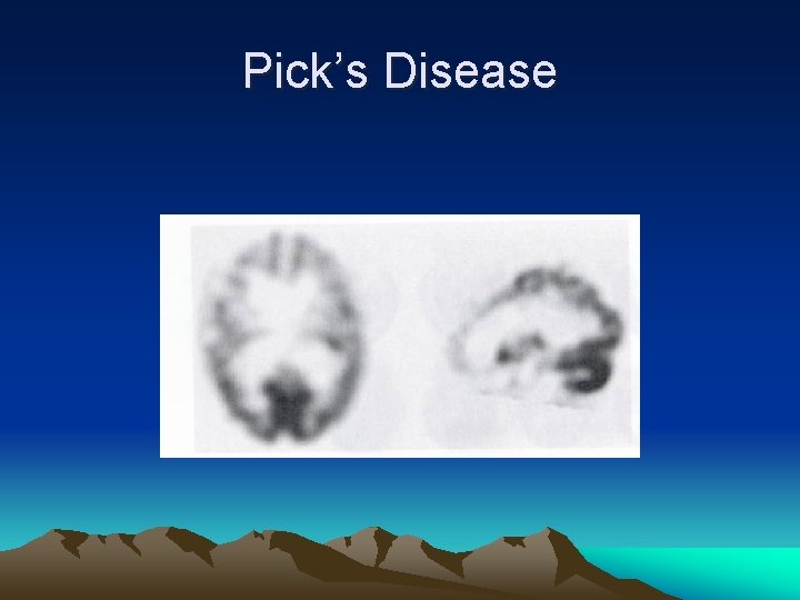 Pick’s Disease 