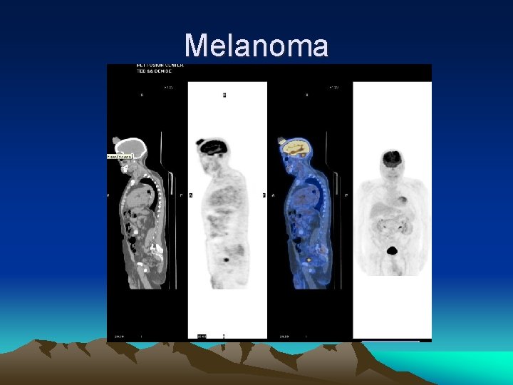 Melanoma 