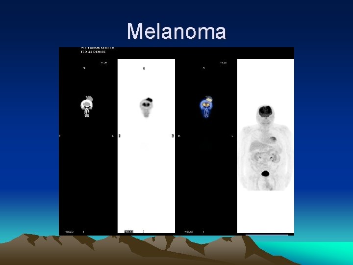 Melanoma 