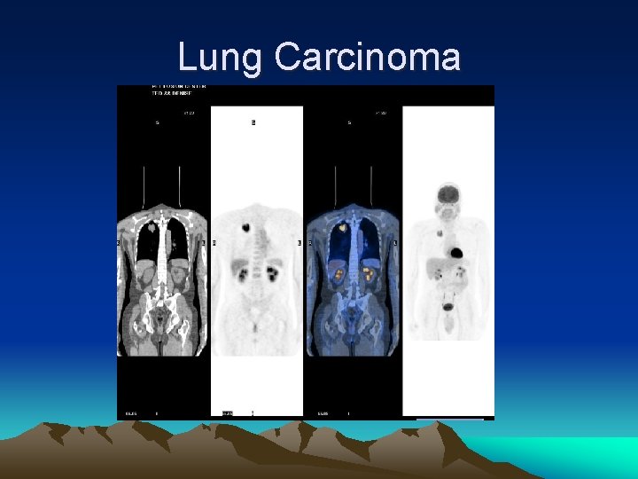 Lung Carcinoma 